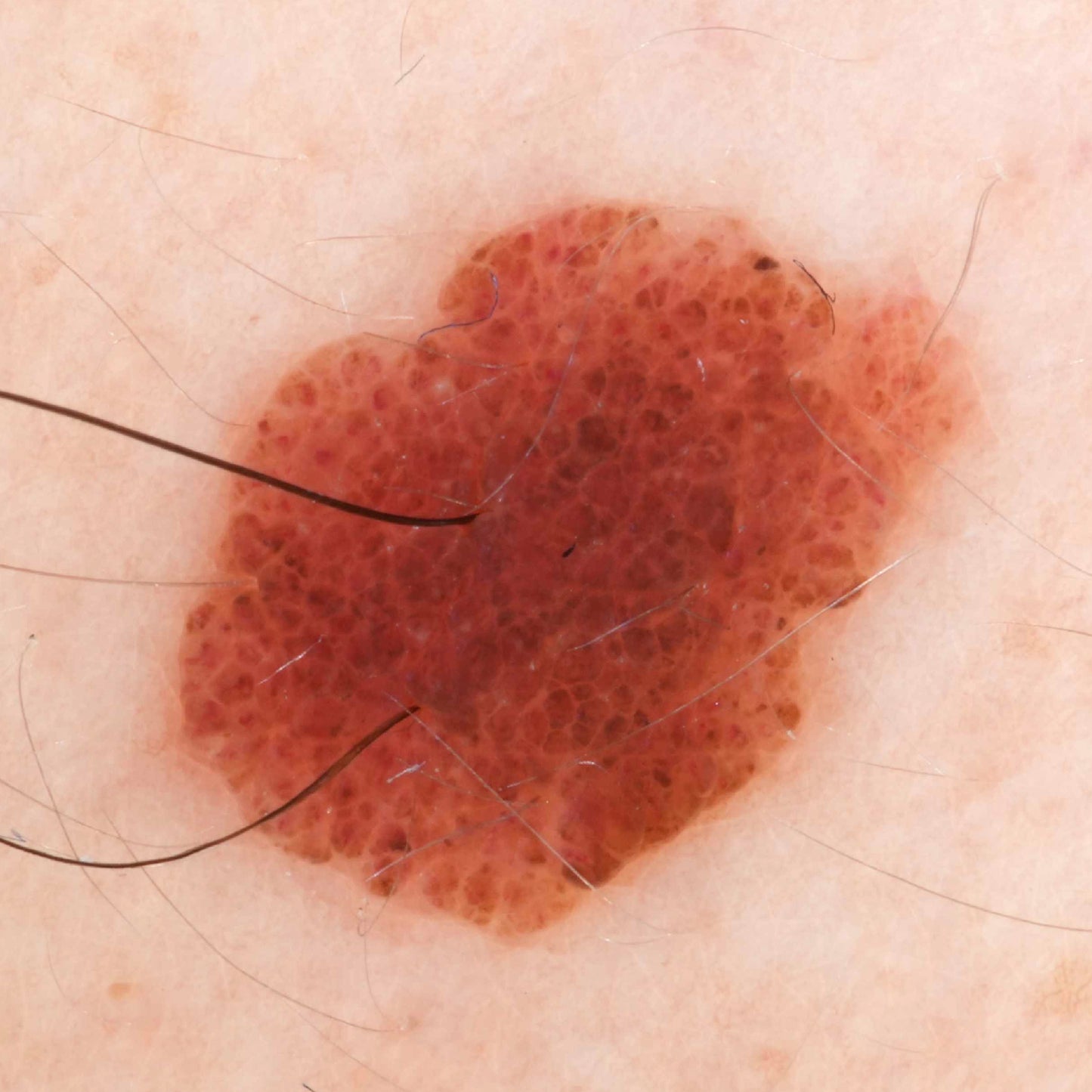 DERMAVISION